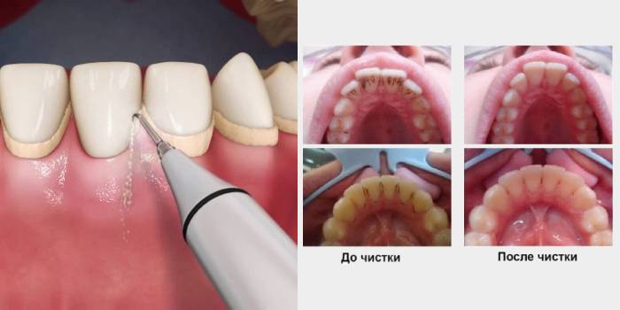 Ultrazvuk na čistenie zubov