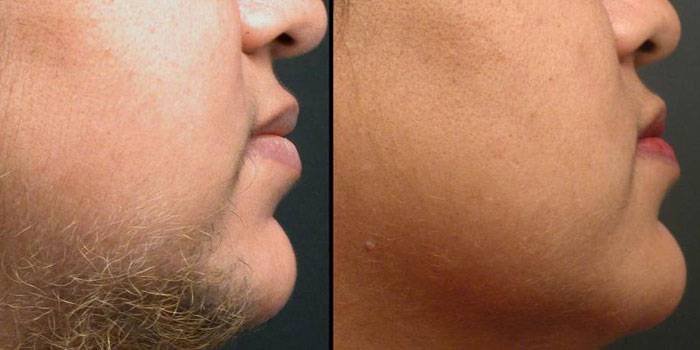 Fotos antes e depois da fotoepilação
