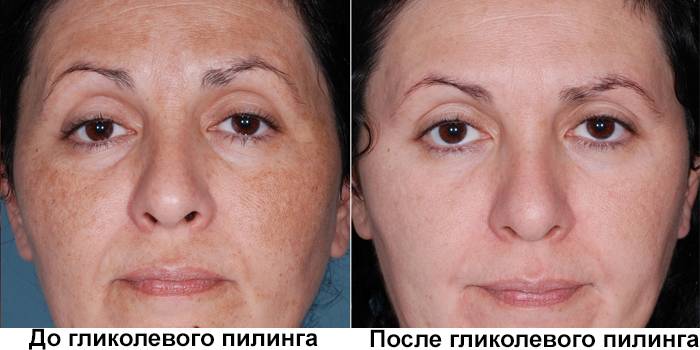 Twarz przed i po peelingu glikolowym