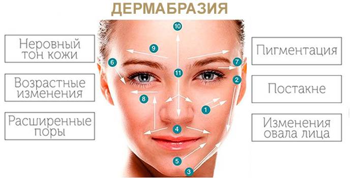 Do czego służy dermabrazja?