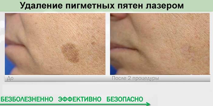 Rezultat usuwania plam laserowych
