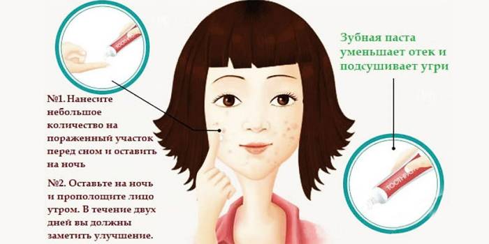 Tratamiento del acné con pasta de dientes