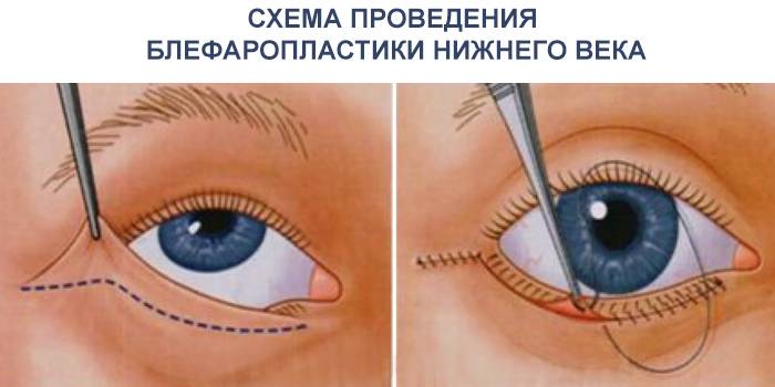 Schemat blepharoplastyki dolnej powieki