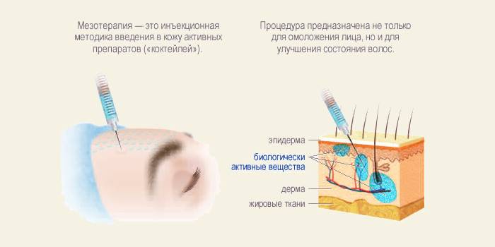 Mesoterapia