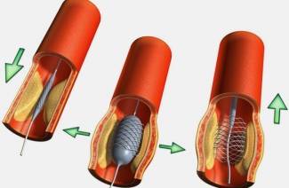 Stent vascular
