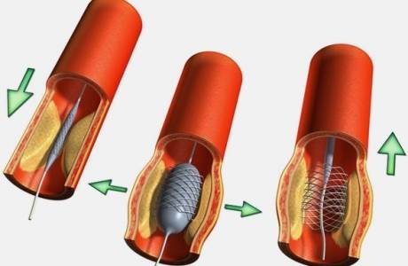 Stent vascular