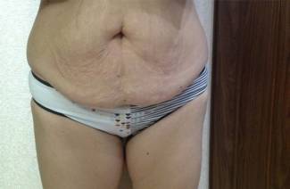 Auto masaje del abdomen