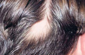 Alopecia areata