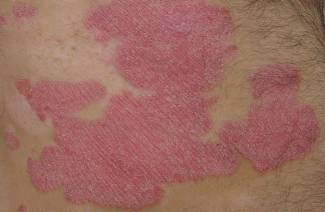 Psoriáza