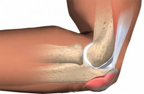 Epicondylitis lakte