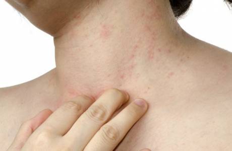 Ekzematózna dermatitída