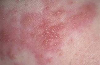 Vücutta herpes tedavisi nasıl