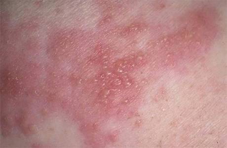 Como tratar o herpes no corpo