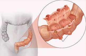 Tratamento de diverticulose intestinal