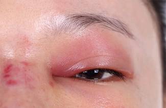 Alergia ao álcool