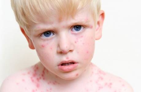 Balsam z ospy wietrznej Calamine