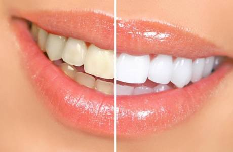 Clareamento dos dentes com peróxido de hidrogênio