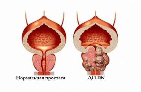 Przerost prostaty