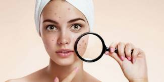 Acne facial em uma farmácia