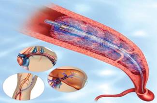 Trombolisis en el accidente cerebrovascular isquémico