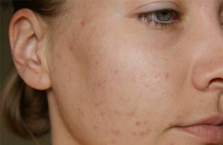 Como remover cicatrizes de acne