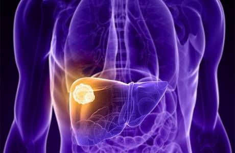 Liečba hepatitídy typu C.
