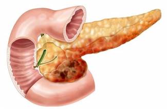 Pancreatite Alcoólica