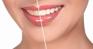 Como blanquear los dientes en casa