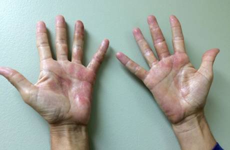 Dermatitis de contacto