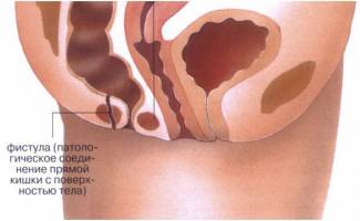 Como tratar la fístula rectal
