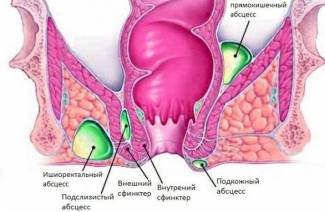 Hemoroidy 2 stupne