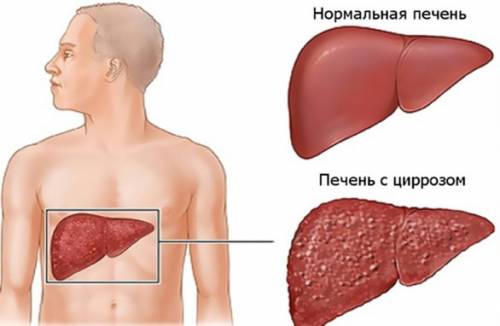 Signos de cirrosis temprana