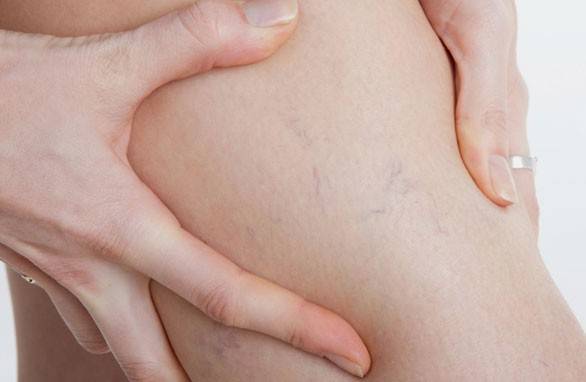 Damarlar, kalp ve kılcal duvarlar nasıl güçlendirilir?