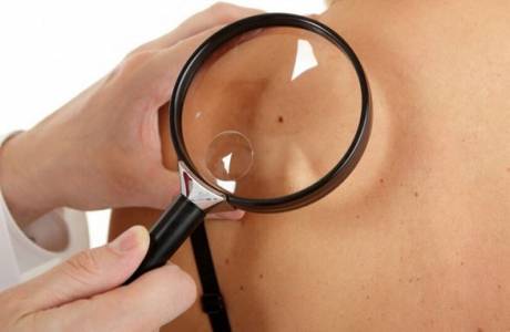 Nevus: ¿qué es eso?
