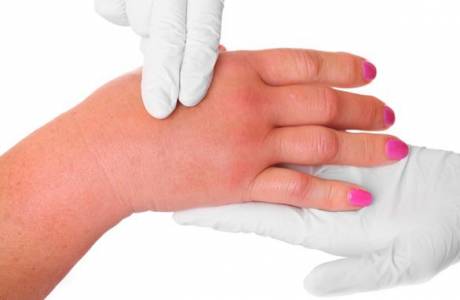 Angioedema