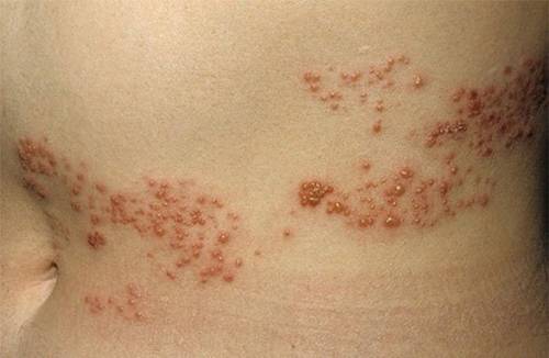 Herpes Zoster