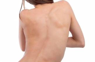 Escoliose