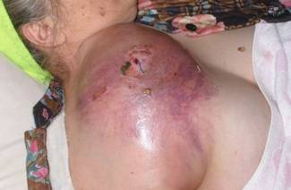 ¿Qué es el sarcoma y cómo tratarlo?