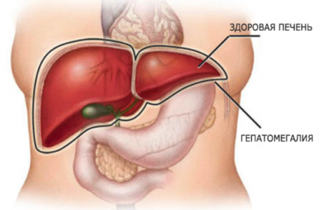 ¿Qué es la hepatomegalia?