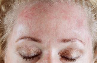 Yüzdeki seboreik dermatit
