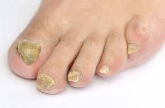 ¿Es posible curar hongos en las uñas?