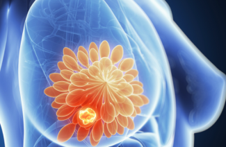 Síntomas y tratamiento de la mastopatía fibroquística.