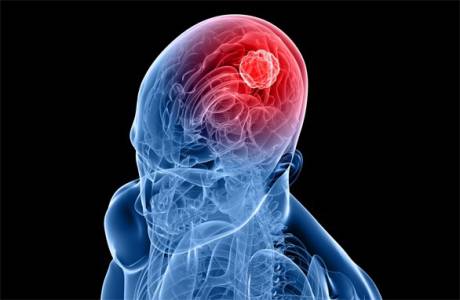 Los síntomas del cáncer cerebral