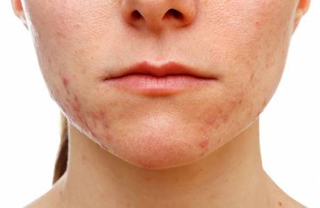 Staphylococcus em adultos