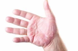 O que é eczema?