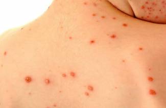 Dermatitis infecciosa