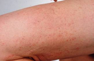Dermatitis en el embarazo