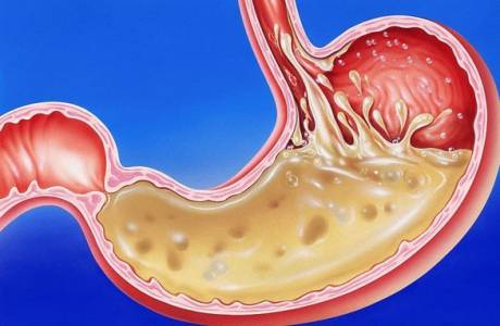 Gastritis con alta acidez.