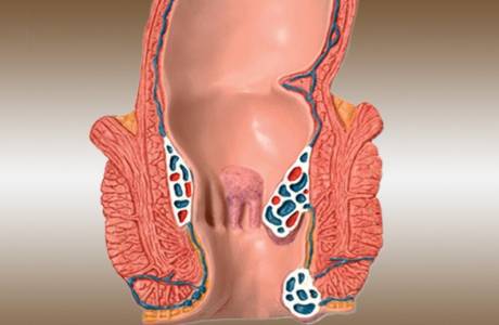 ¿Cómo identificar las hemorroides?