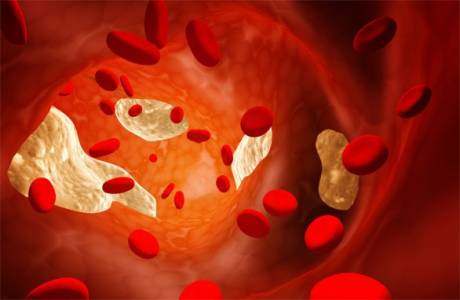 LDL cholesterol